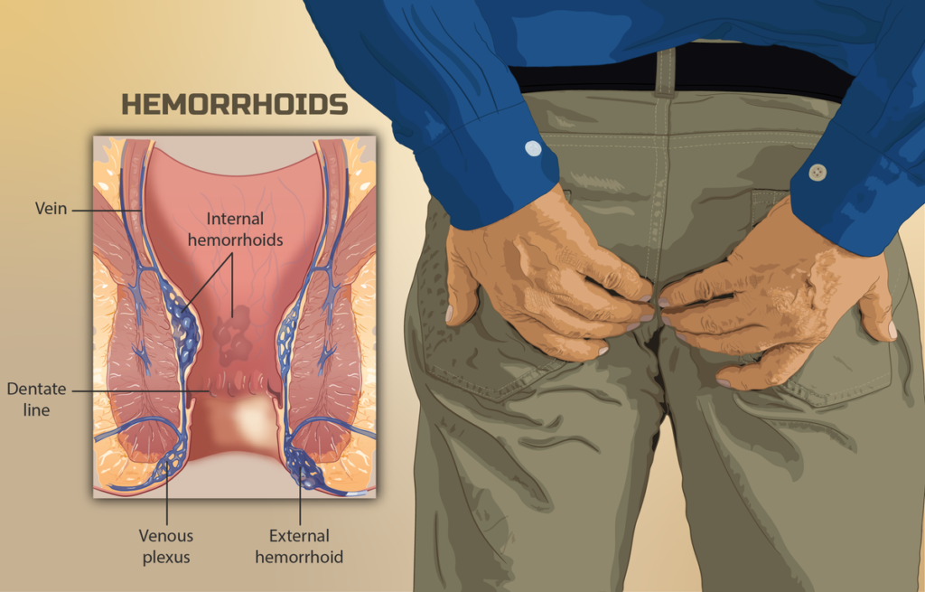 Coping With The Emotional Impacts of Hemorrhoids