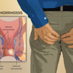 Coping With The Emotional Impacts of Hemorrhoids