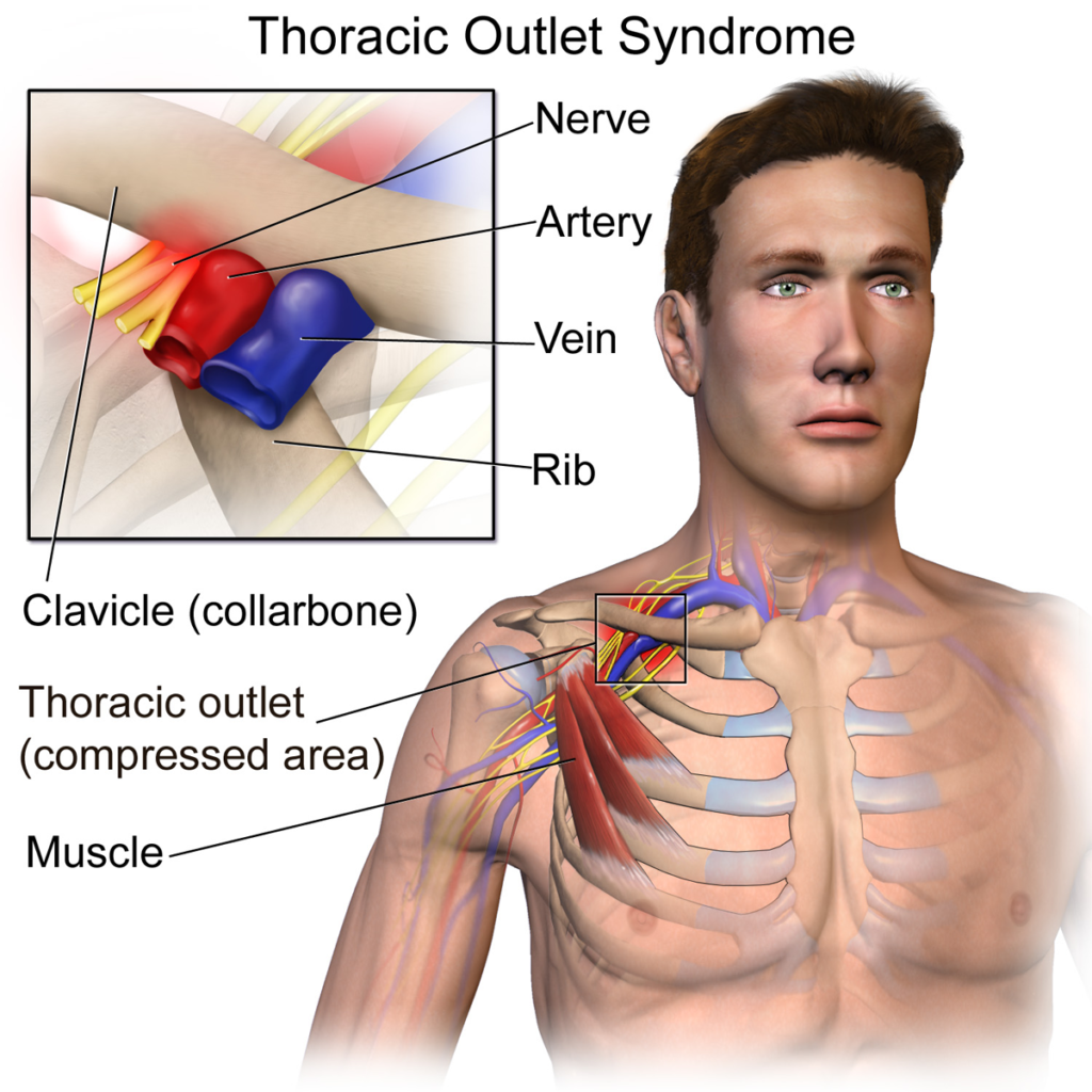 Thoracic Outlet Syndrome Sleeping Position Tips